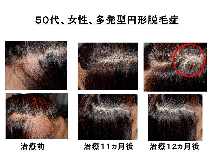 円形脱毛症　病院